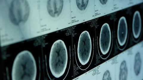 moving head pet cT scan,skull brain X-ray.