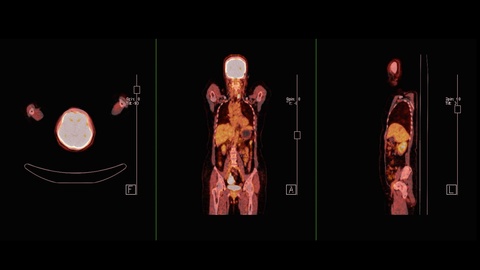 PET CT of human whole body