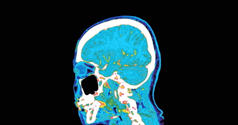 CTA Brain SCAN of the brain in colorful mode or PET CT Scan.